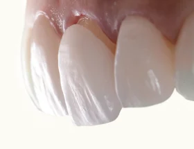 How To Maintain Your Veneers After Placement