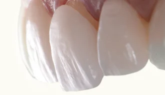 How To Maintain Your Veneers After Placement