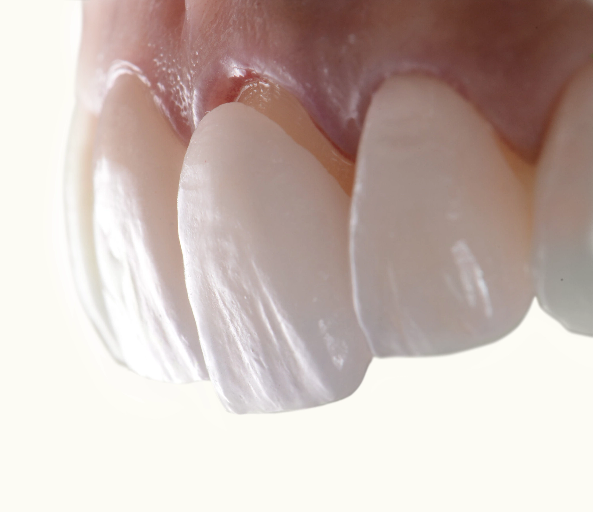 How To Maintain Your Veneers After Placement